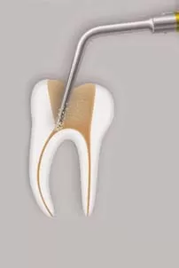 Заказать Насадка для скалера #CAP1 | Acteon в интернет-магазине dialog.dental