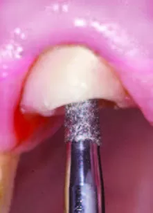 Заказать Насадка для скалера #PM4 | Acteon в интернет-магазине dialog.dental